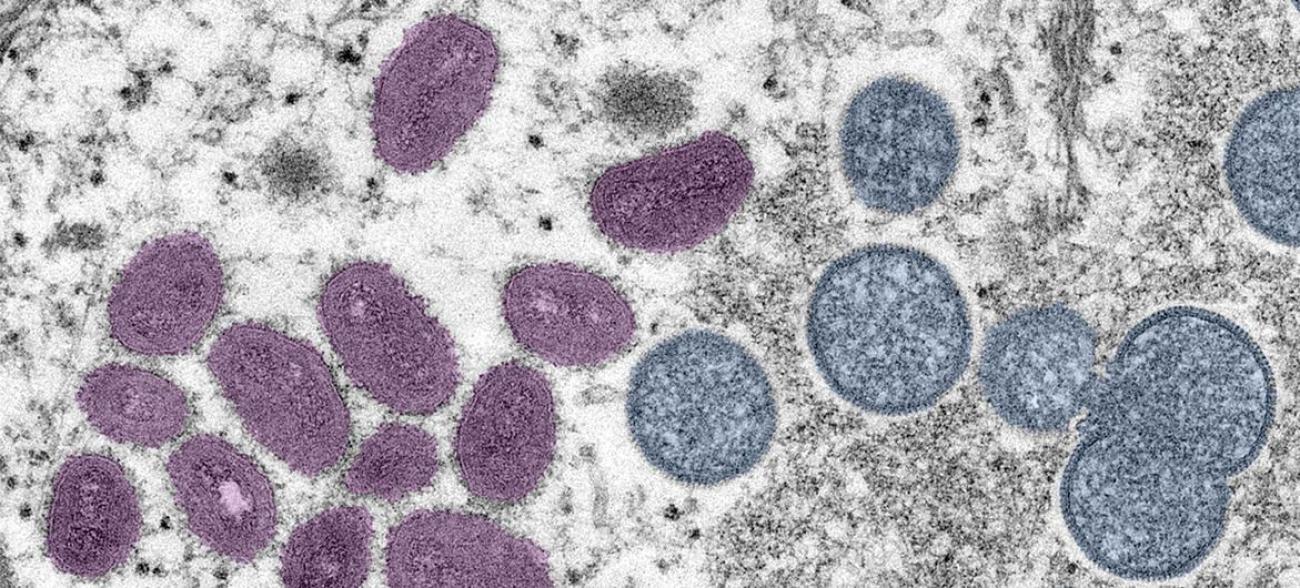 Niassa soma 4 casos positivos de mpox