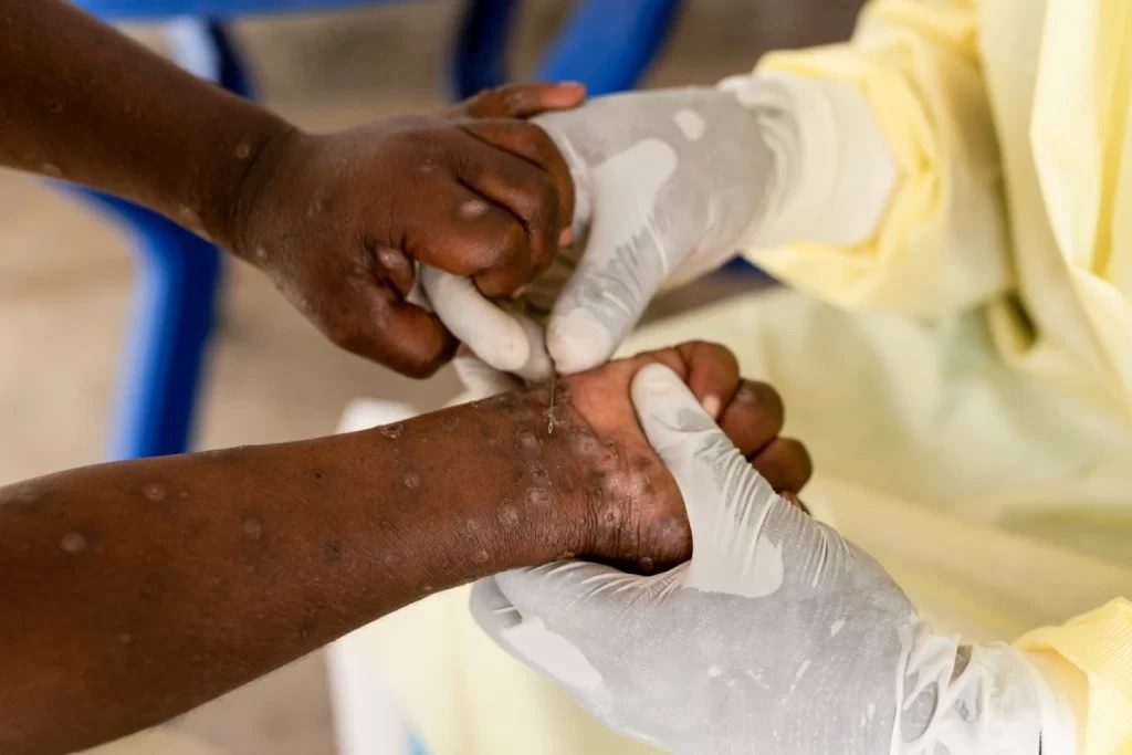 Pr adverte sobre o aumento de casos de mpox no