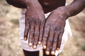 Província de maputo já tem um caso de mpox e