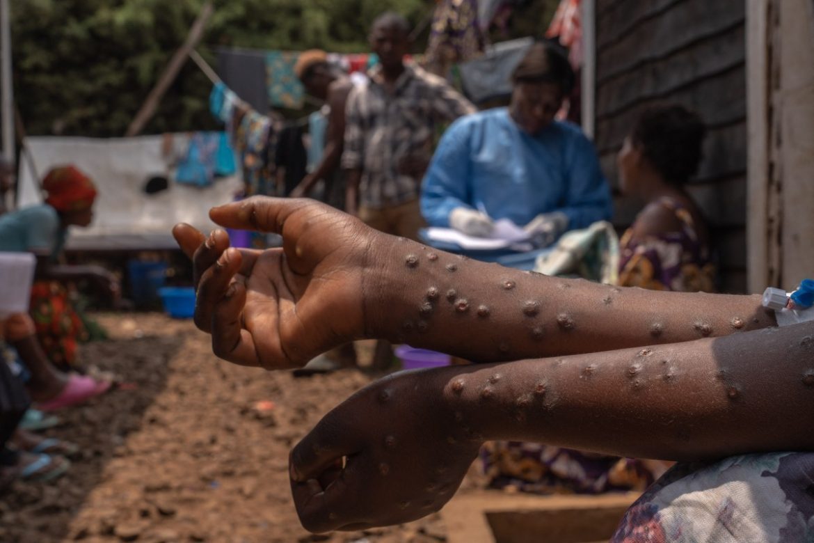 Sofala: nhamatanda em alerta para responder à emergência da mpox