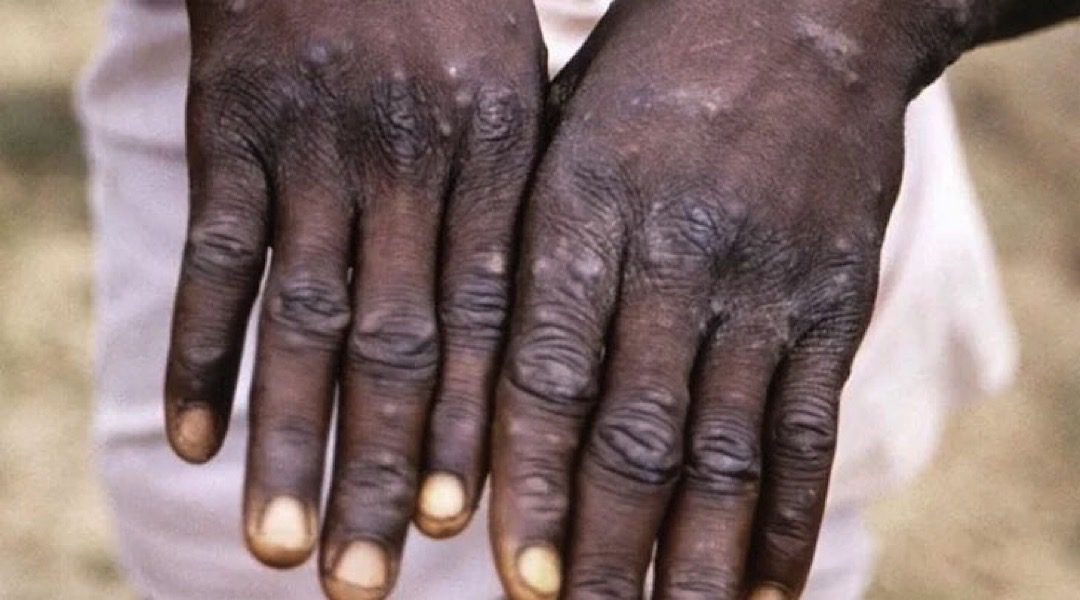  oms anuncia que mpox deixou de ser uma emergência de