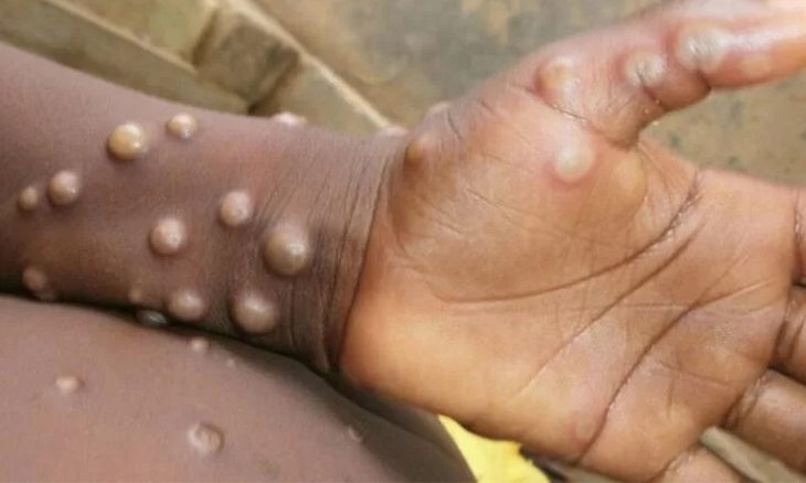 País conta com registo de 57 pacientes recuperados da mpox