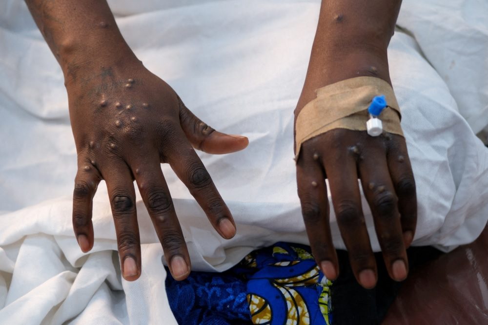  tete notifica primeiro caso positivo da mpox