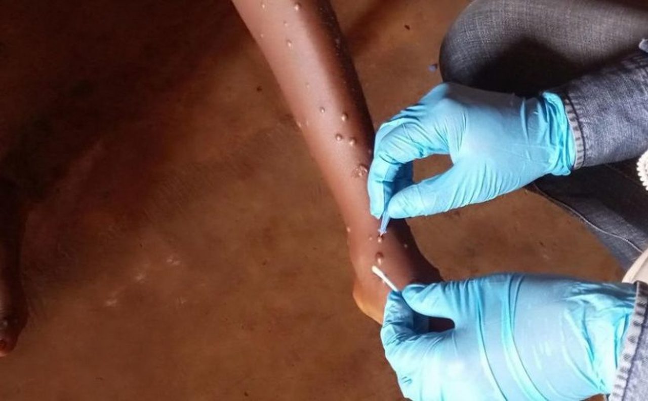 Teteː confirmado dois casos de mpox