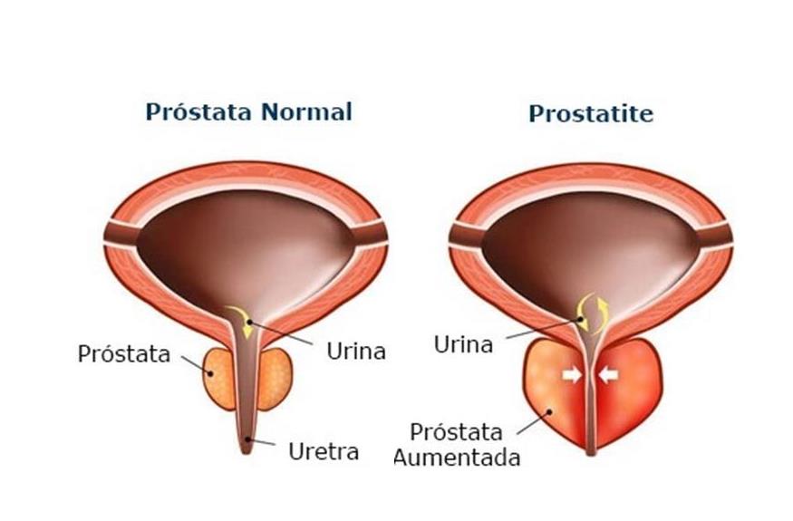 Aumenta casos do cancro da próstata