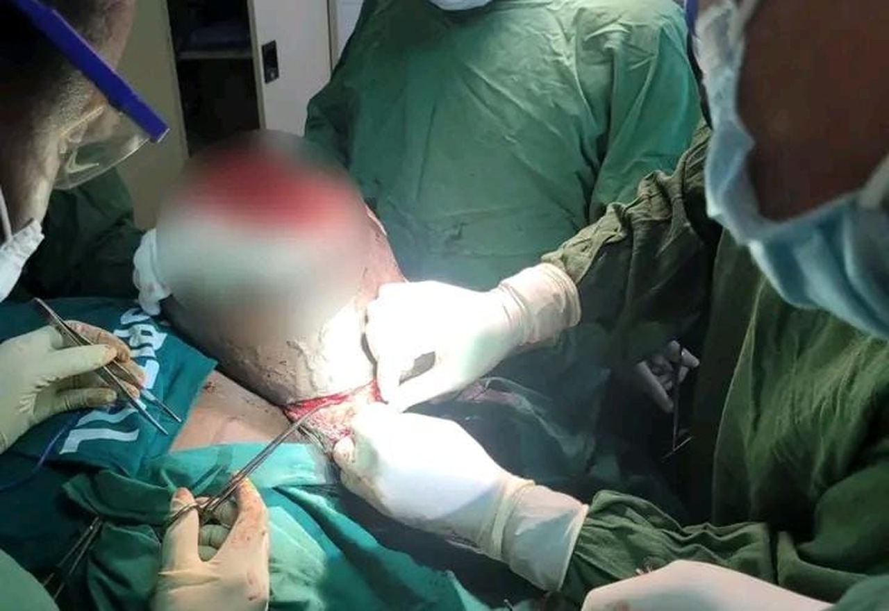 Hospital Central da Beira remove tumor de sete quilos em