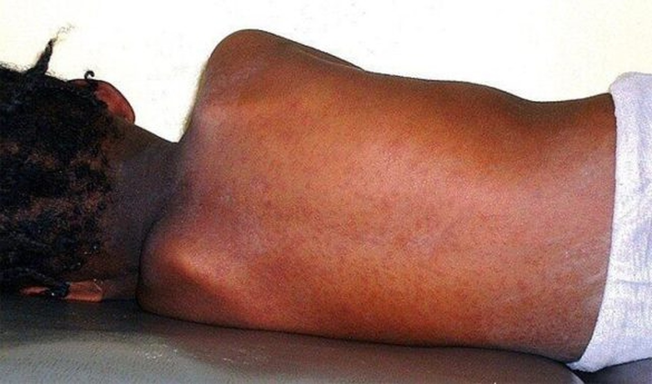 Moçambique com quase 700 casos de sarampo em sete meses